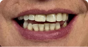 Имплантация зубов в Перми