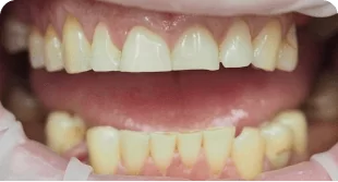 Имплантация зубов в Перми